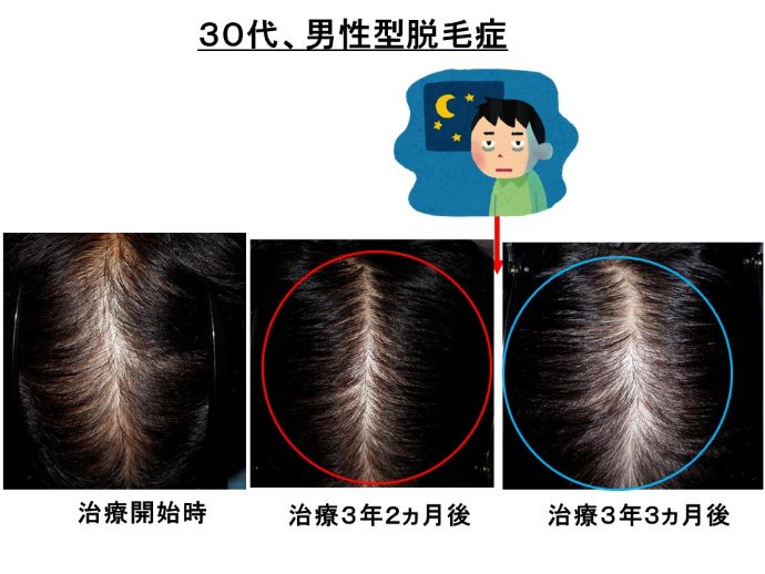 円形脱毛症　病院